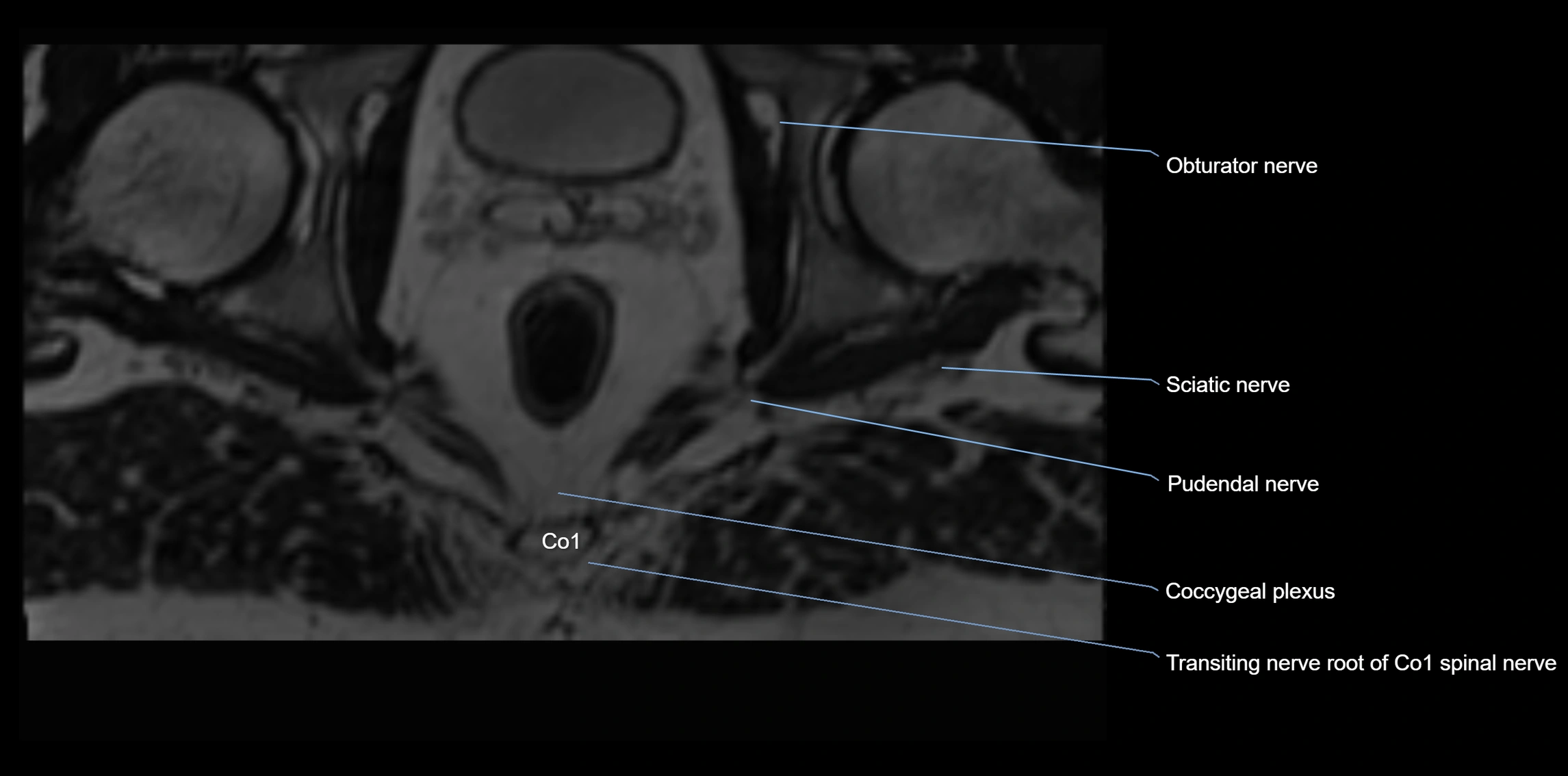 MR lumbosacral plexus axial cross sectional anatomy 3T  radiology  image-img-1008001-00126.webp